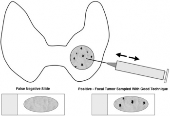 CPT Nodule